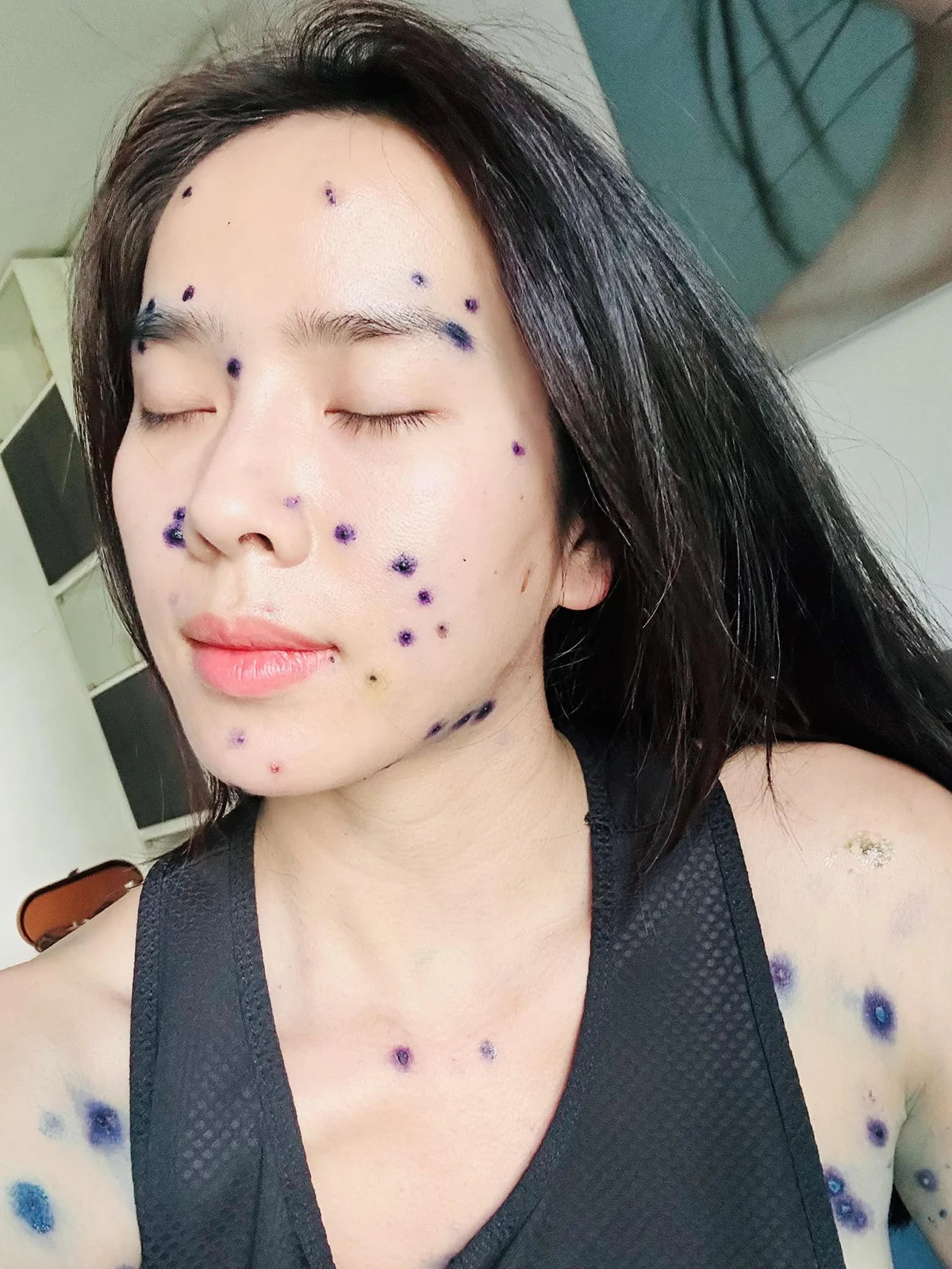 Bella Mai trong thời gian điều trị căn bệnh thủy đậu Bella Mai trong thời gian điều trị căn bệnh thủy đậu
