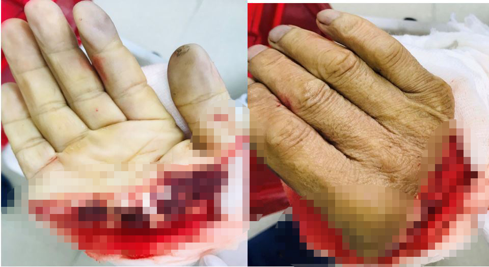 Cận cảnh bàn tay bị đứt lìa Cận cảnh bàn tay bị đứt lìa