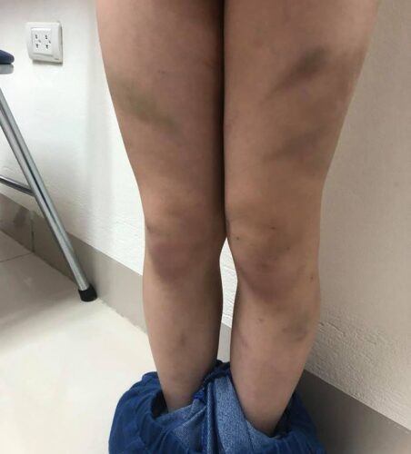 Những vết thương bầm tím nằm dải rác trên đùi của bé