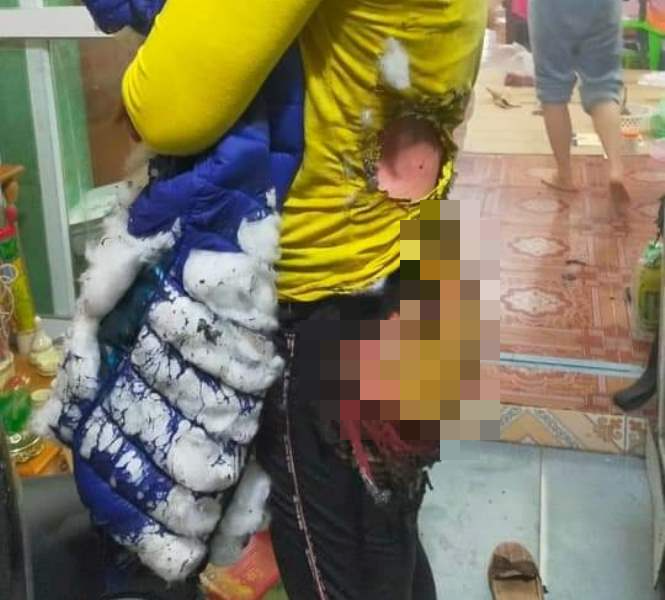 Chị H. đang điều trị tại Hà Nội với một vết bỏng ở toàn bộ chân lên tới lưng và cả 2 tay. Chị H. đang điều trị tại Hà Nội với một vết bỏng ở toàn bộ chân lên tới lưng và cả 2 tay